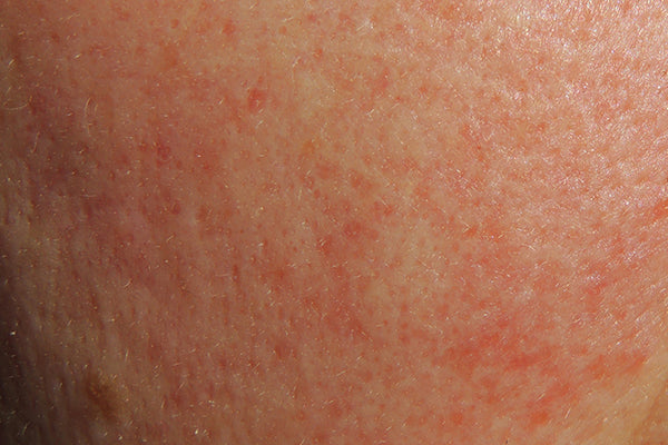 Redness on the face can have multiple causes