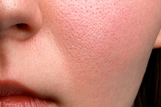 Enlarged pores make it difficult to keep skin clear.