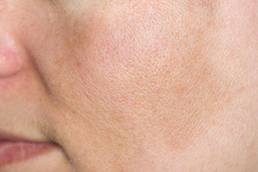 Pregnancy mask: FILORGA tells you everything about melasma.